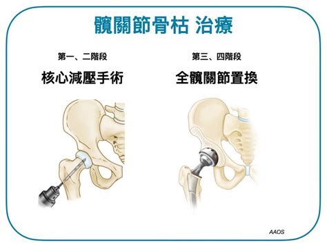 骨枯手術費用|骨科 